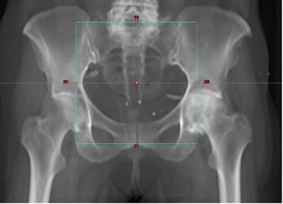 Fiducial markers in adjuvant setting for a patient affected by endometrial cancer: a case report